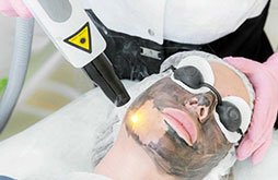 Carbon Peel Treatment