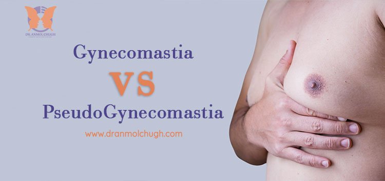 What is the difference between Gynecomastia and PseudoGynecomastia