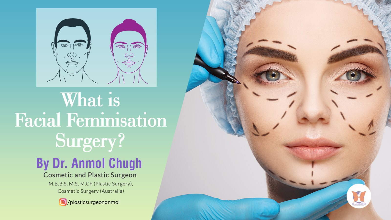 Facial Feminisation Surgery: Things You Should Know