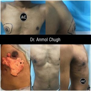 Case studies-Unilateral Gynecomastia