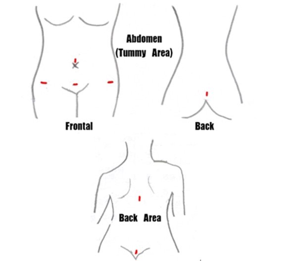 Tummy Liposuction