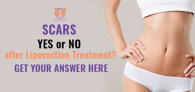 Will I have scars after Liposuction Treatment