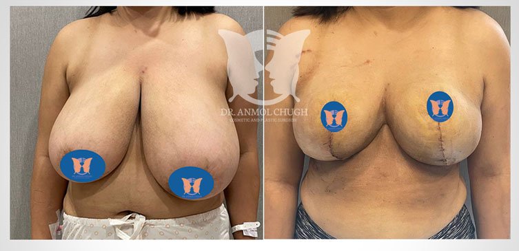 Breast Reduction Surgery - Before and after