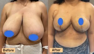35-44 year old woman treated with Breast Reduction