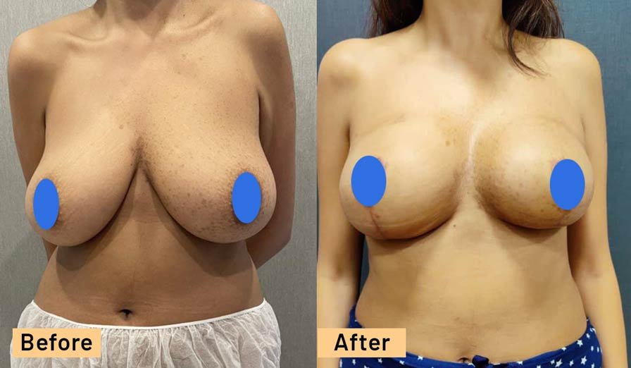 Breast Reduction Result