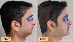 Chin Implant Results