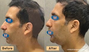 42 year old man treated with Chin Implant