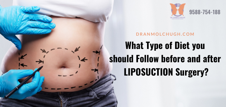 What Type of Diet you should Follow before and after LIPOSUCTION Surgery