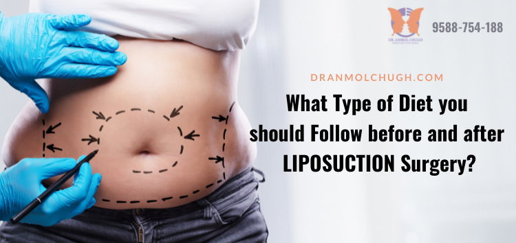 Upper Body Liposuction: How to Achieve Best Results in 2024? -  International Clinics