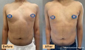 Gynecomastia Results - Male Boobs Surgery