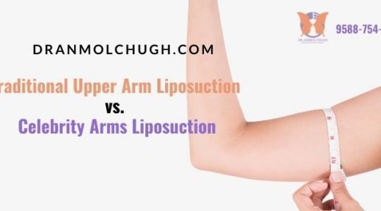 Traditional Upper Arm Liposuction vs. Celebrity Arms Liposuction