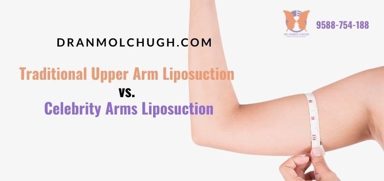 Traditional Upper Arm Liposuction vs. Celebrity Arms Liposuction