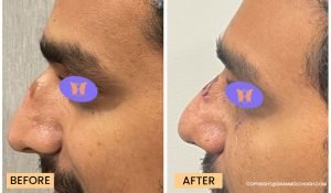 rhinoplasty surgery before after
