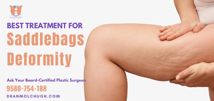 What is the best treatment to get rid of Saddlebags deformity?