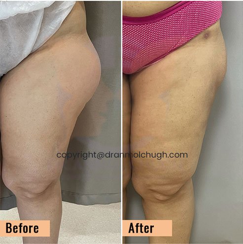 Get rid of saddlebags and cellulite sale