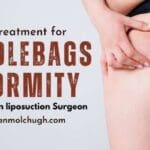 saddlebags deformity liposuction treatment