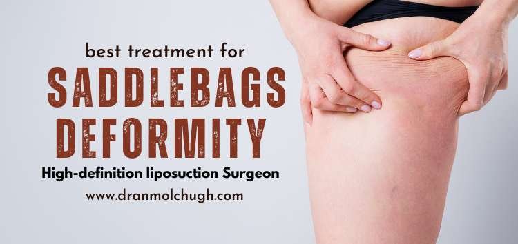 saddlebags deformity liposuction treatment
