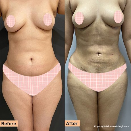 Female Liposuction in Delhi NCR