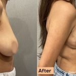 36 year old woman treated with Breast Lift, Breast Reduction