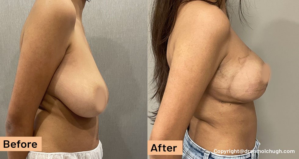 36 year old woman treated with Breast Lift, Breast Reduction