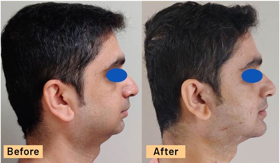 Chin Implant Male Patient Side view