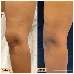 Elbow liposuction under Local Anaesthesia