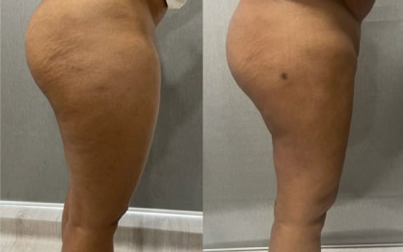 Thigh liposuction, 2 months postop, 32 year old female