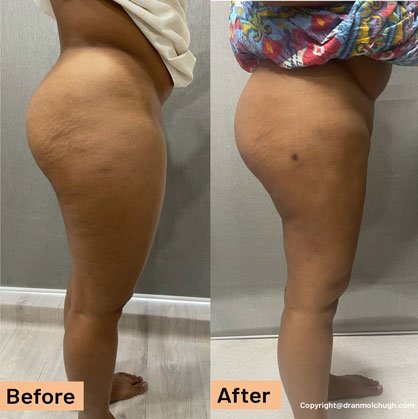 Thigh liposuction, 2 months postop, 32 year old female