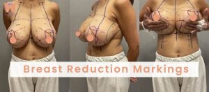 Breast Reduction Markings
