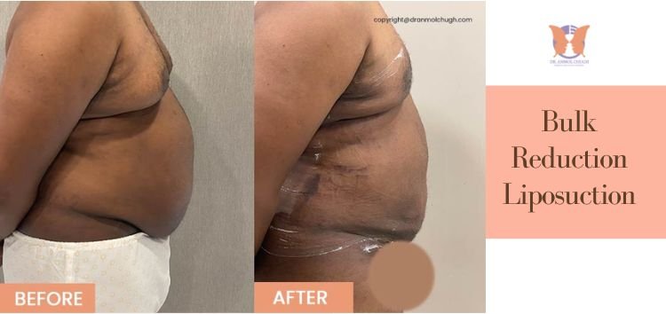 Bulk Reduction Liposuction