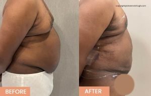 Bulk Reduction Liposuction