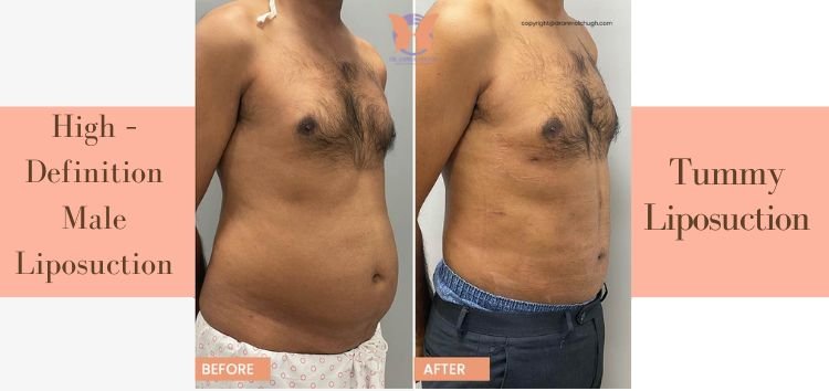 Liposuction of flanks Care Well Medical Centre