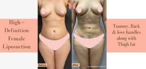High – Definition Female Liposuction