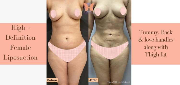 Case Study: High - Definition Female Liposuction in Delhi NCR