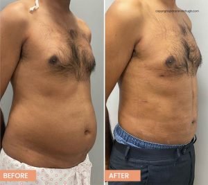 Tummy Liposuction Results - Male High-Definition Abdomen