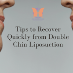 How Long Does Double Chin Liposuction Results Last