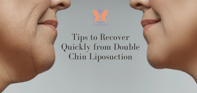 How Long Does Double Chin Liposuction Results Last