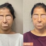 Buccal Fat Removal for Female