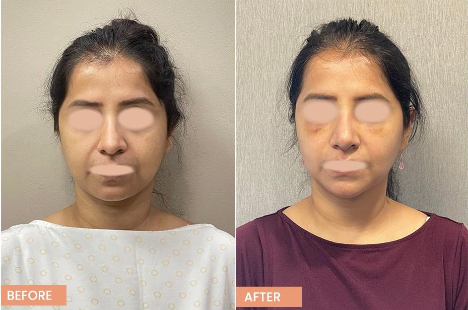 Buccal Fat Removal for Female