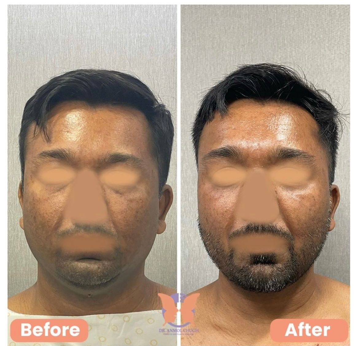 Buccal Fat Surgery Cost in Gurgaon, Buccal fat Removal in Delhi NCR