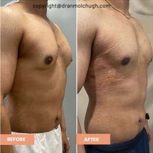 Gynecomastia Grade 2, 27 year old male, 1 week postop