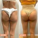 Brazilian Butt Lift Results