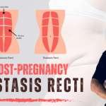 What Post-Pregnancy Moms Should Know About Diastasis Recti