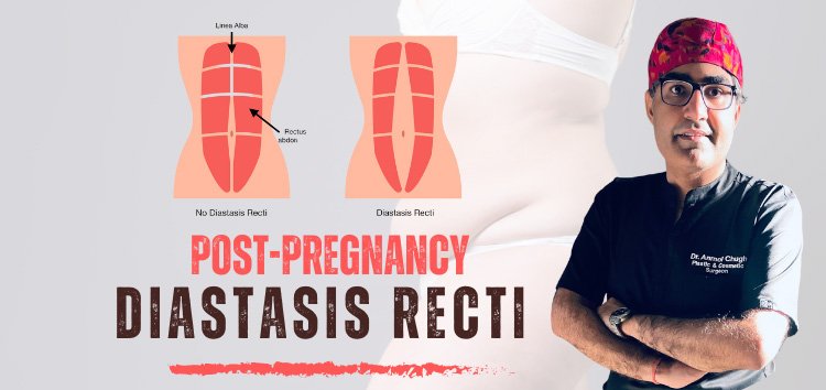What Post-Pregnancy Moms Should Know About Diastasis Recti
