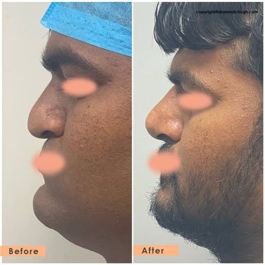 Cleft Nasal Deformity and Rhinoplasty results