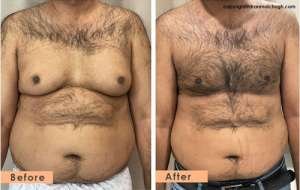 Grade 4 Gynecomastia, 37 year old male, 3 months post op
