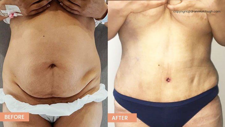 42 year old woman treated with Tummy Tuck