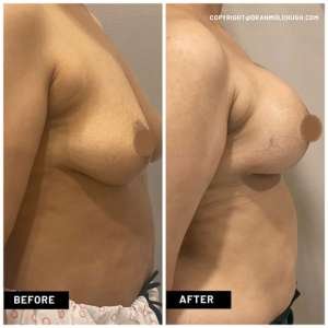 Breast Implant Results