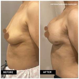 Breast Augmentation with Implants