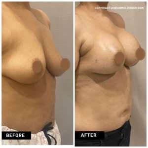 Breast Augmentation with Implants in India